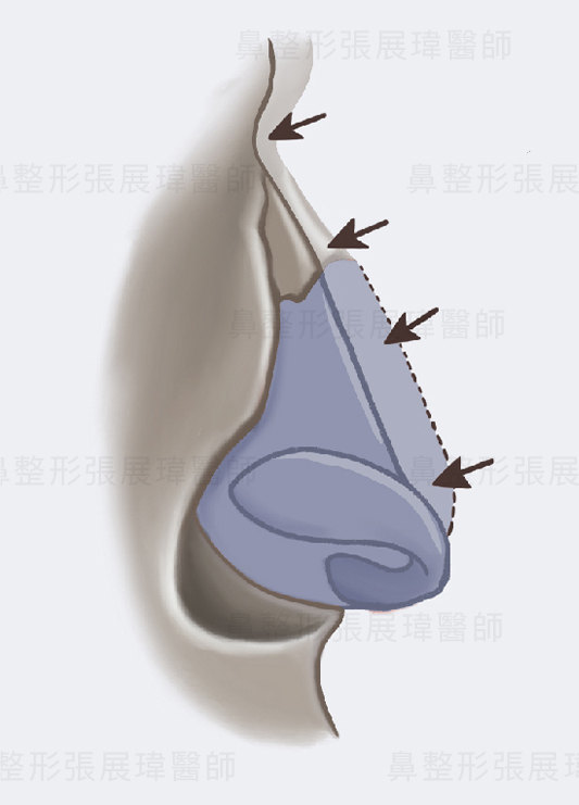 馬鞍鼻矯正 – AR進階鼻美學時尚診所