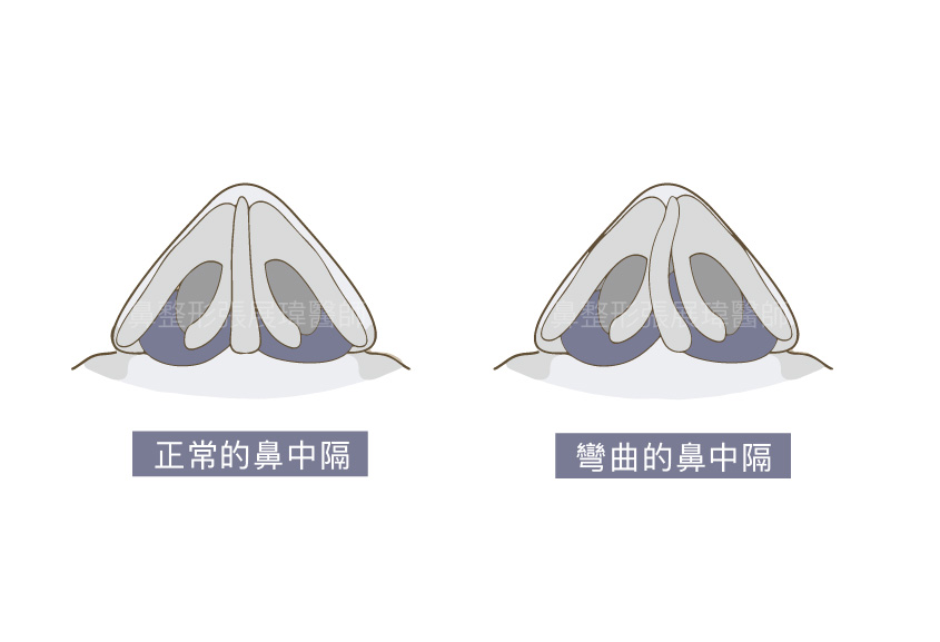 鼻中隔彎曲矯正 – AR進階鼻美學時尚診所